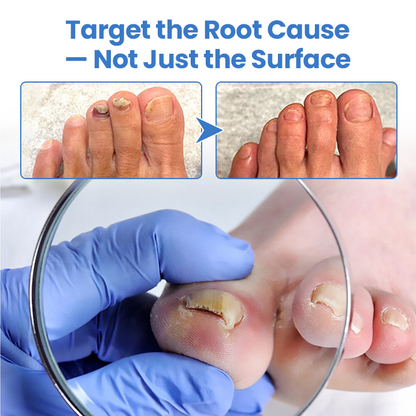 Cvreoz® MycoErase Nail Revive Pen