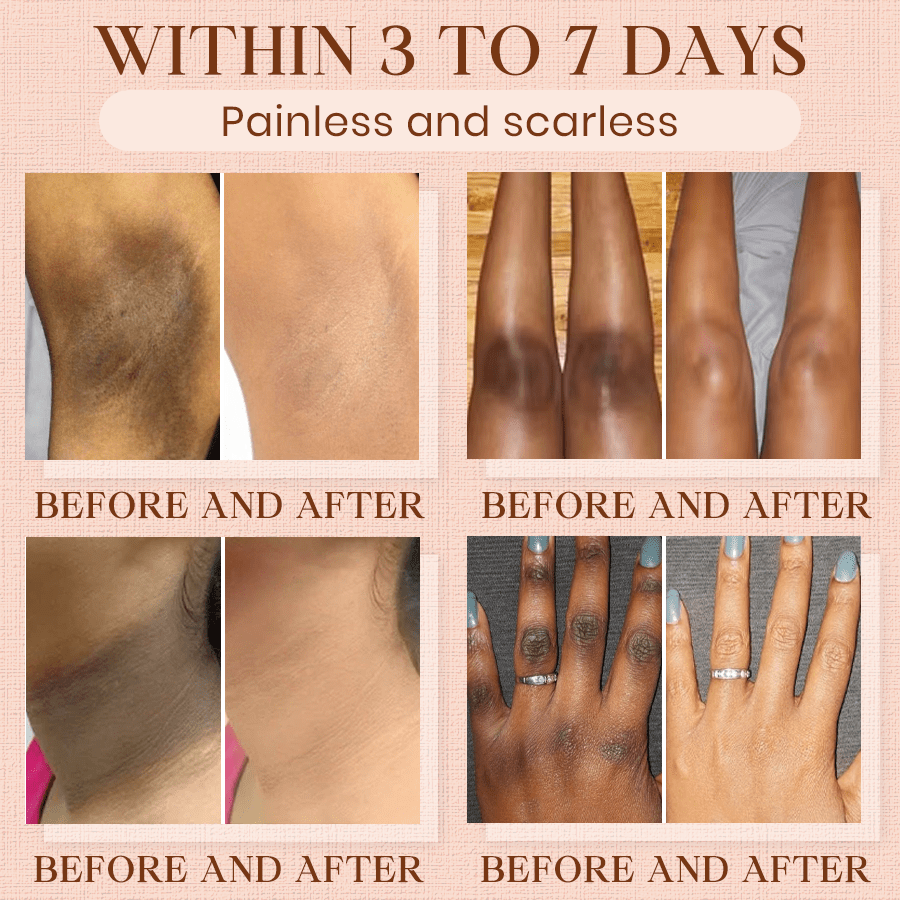 Cvreoz® Purifying Exfoliating Gel for Acanthosis Nigricans, Exfoliation, Dark Spots, Skin Tags, and Eczema ❣️