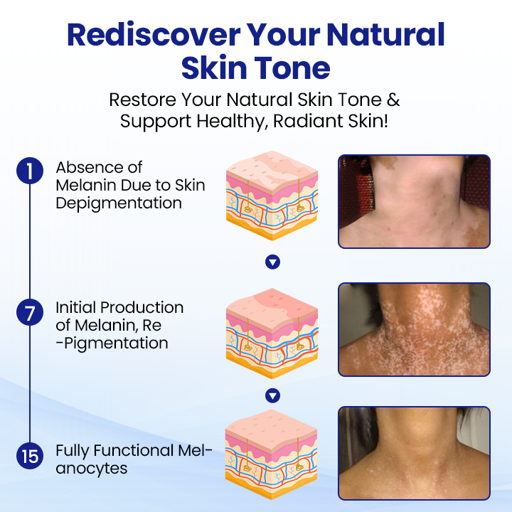 Cvreoz® Vitiligo Treatment Spray — Visible Results in Weeks, 100% Natural & Steroid-Free