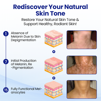 Cvreoz® Vitiligo Treatment Spray — Visible Results in Weeks, 100% Natural & Steroid-Free