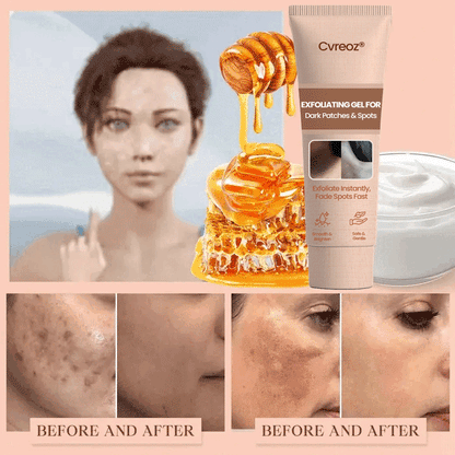 Cvreoz® Purifying Exfoliating Gel for Acanthosis Nigricans, Exfoliation, Dark Spots, Skin Tags, and Eczema ❣️