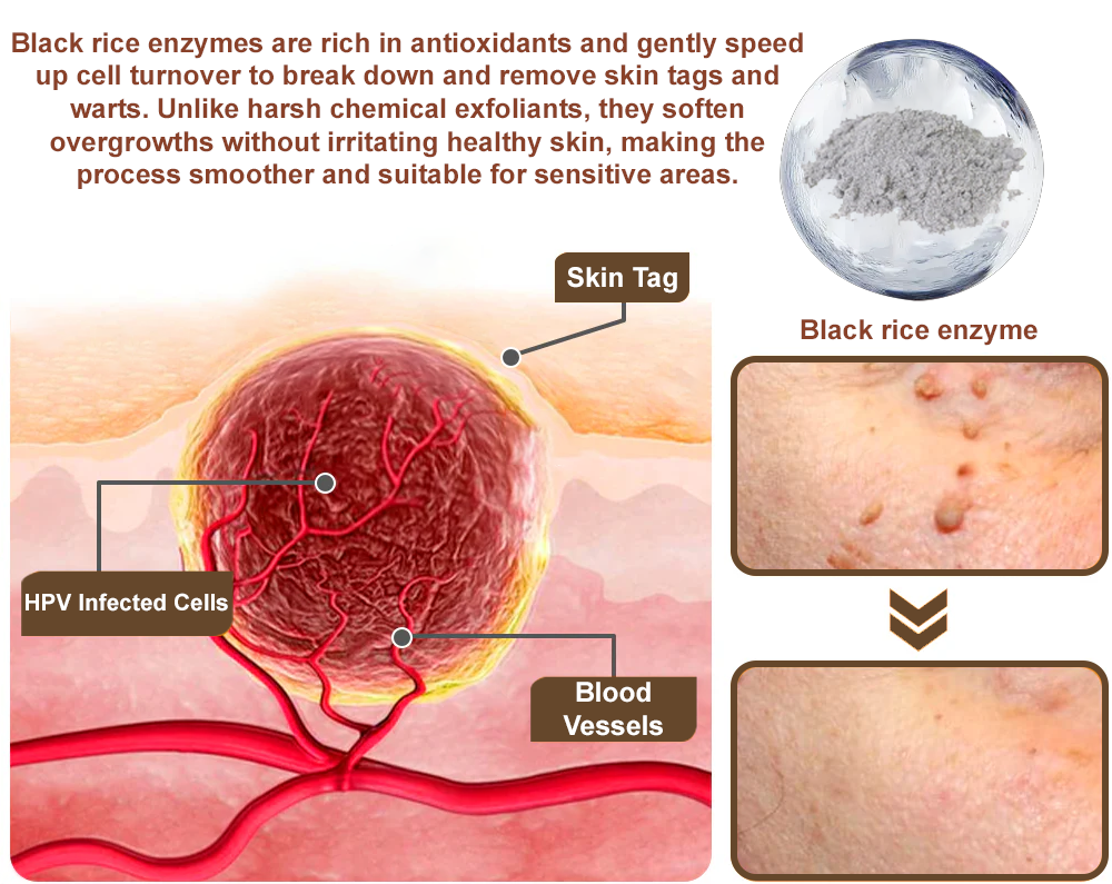 Cvreoz® OryzaClear Wart & Tag Remover Cream 👨‍⚕️ FDA Approved (Gentle & Effective Formula for Smoother Skin)