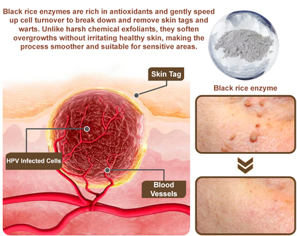 Cvreoz® OryzaClear Wart & Tag Remover Cream 👨‍⚕️ FDA Approved (Gentle & Effective Formula for Smoother Skin)