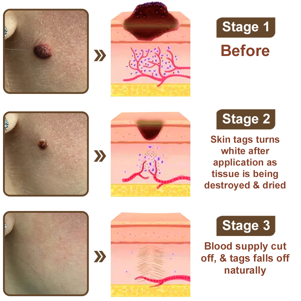 Cvreoz® OryzaClear Wart & Tag Remover Cream 👨‍⚕️ FDA Approved (Gentle & Effective Formula for Smoother Skin)