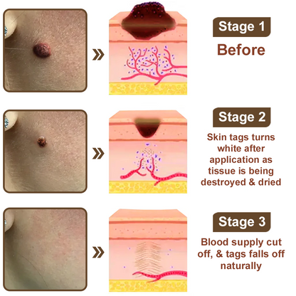 Cvreoz® OryzaClear Wart & Tag Remover Cream 👨‍⚕️ FDA Approved (Gentle & Effective Formula for Smoother Skin)