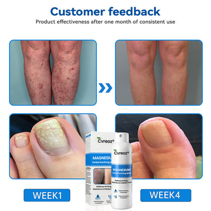 ✅  Official Store: Cvreoz® Magnesium Herbal Psoriasis Spray ⚕️ FDA Certified (for the treatment of psoriasis and eczema, improvement of bacterial infections in the genital area, treatment of acne and warts, eliminates psoriasis and eczema, etc.) (zth)