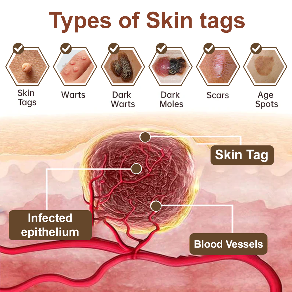 Cvreoz® OryzaClear Wart & Tag Remover Cream 👨‍⚕️ FDA Approved (Gentle & Effective Formula for Smoother Skin)