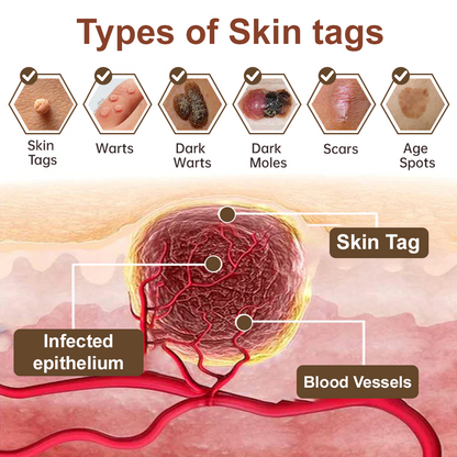 Cvreoz® OryzaClear Wart & Tag Remover Cream 👨‍⚕️ FDA Approved (Gentle & Effective Formula for Smoother Skin)