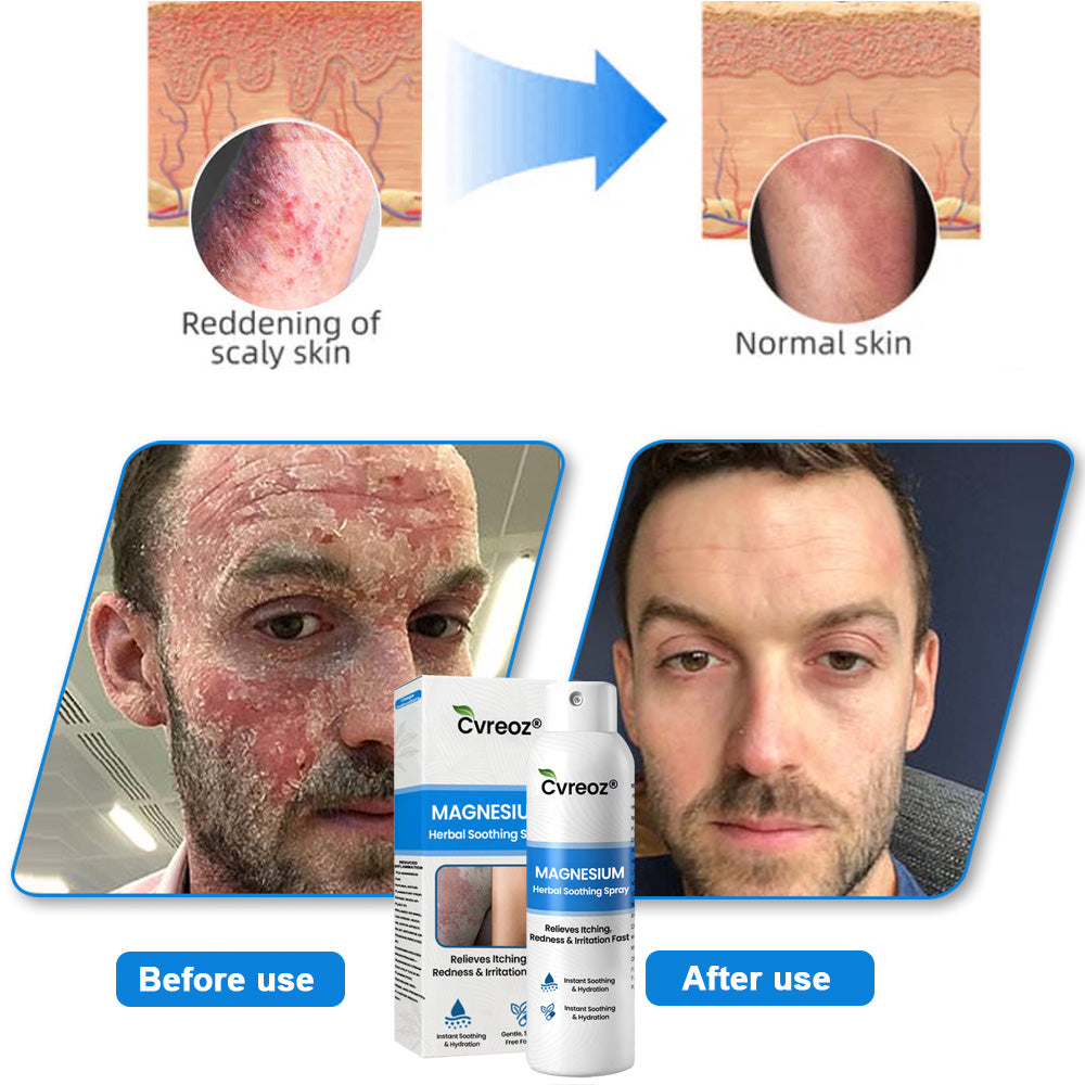✅  Official Store: Cvreoz® Magnesium Herbal Psoriasis Spray ⚕️ FDA Certified (for the treatment of psoriasis and eczema, improvement of bacterial infections in the genital area, treatment of acne and warts, eliminates psoriasis and eczema, etc.) (zth)