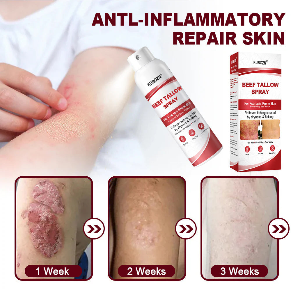KUBOZN® Tallow Spray — The No-Rub Relief for Psoriasis-Prone Skin✨