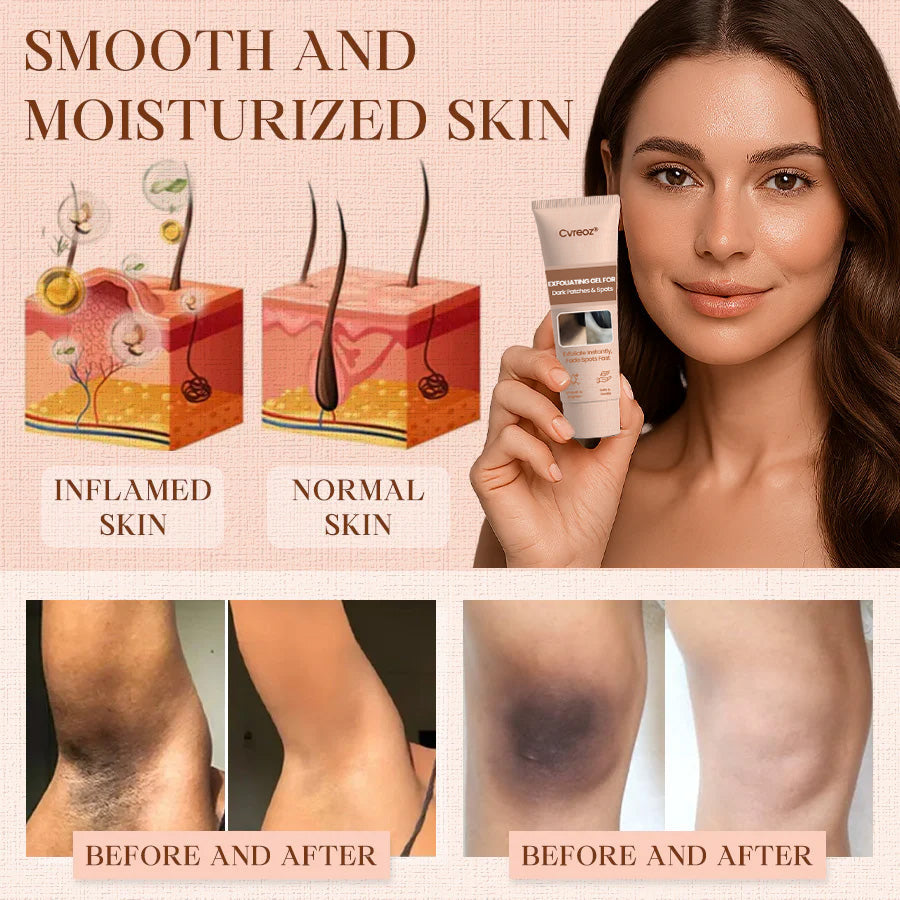 Cvreoz® Purifying Exfoliating Gel for Acanthosis Nigricans, Exfoliation, Dark Spots, Skin Tags, and Eczema ❣️
