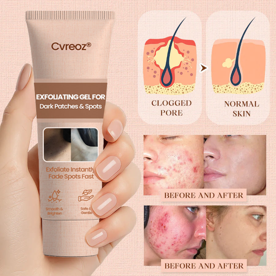 Cvreoz® Purifying Exfoliating Gel for Acanthosis Nigricans, Exfoliation, Dark Spots, Skin Tags, and Eczema ❣️