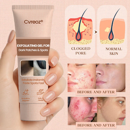 Cvreoz® Purifying Exfoliating Gel for Acanthosis Nigricans, Exfoliation, Dark Spots, Skin Tags, and Eczema ❣️