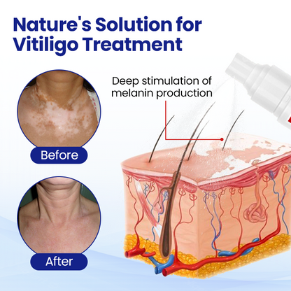 Cvreoz® Vitiligo Treatment Spray — Visible Results in Weeks, 100% Natural & Steroid-Free