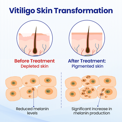 Cvreoz® Vitiligo Treatment Spray — Visible Results in Weeks, 100% Natural & Steroid-Free